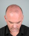 Before Hair Transplant&nbsp;2 Sessions (Areas)